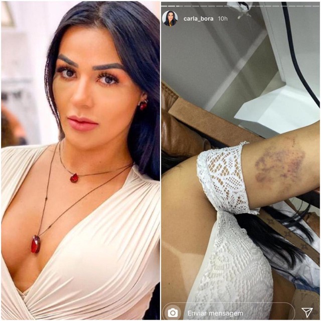 Influenciadora posta foto de hematomas e diz ter sido agredida por namorado