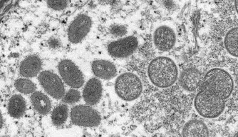 Vírus Monkeypox
