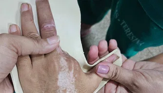 HUT produz e adapta órteses para pacientes internados