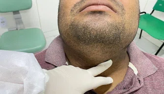 cancer bucal, boca