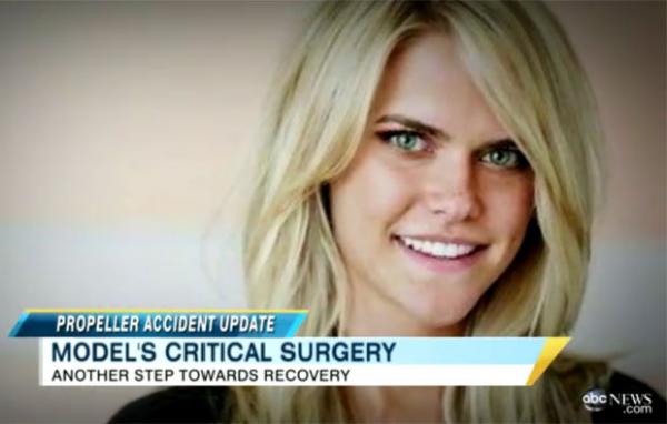 Após ter uma mão decepada no acidente, Lauren Scruggs teve o olho esquerdo removido (Imagem:Reprodução)
